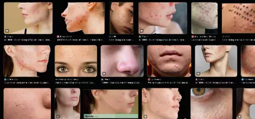 fotos de acne, espinillas o granitos